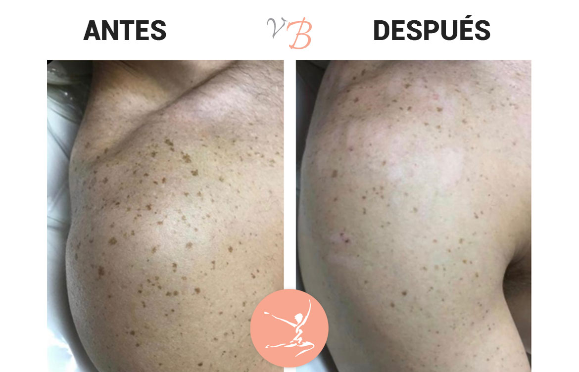 antes-despues-12